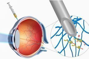 Nanoroboter dringen ins Auge vor